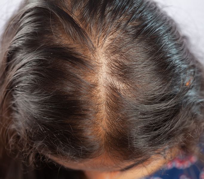 Alopecia androgenética