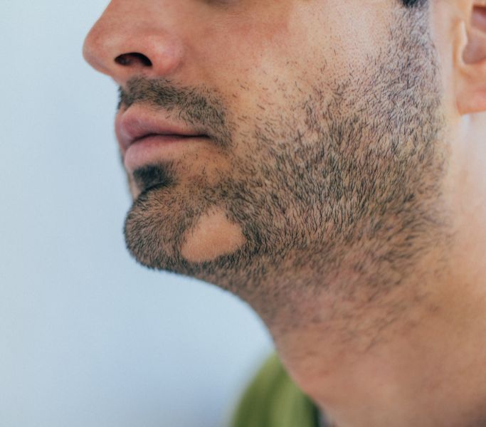 Alopecia areata