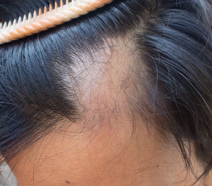 Alopecia frontal fibrosante