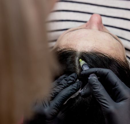 Mesoterapia capilar