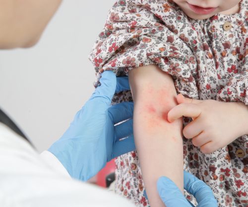 brotes de eczema infantil