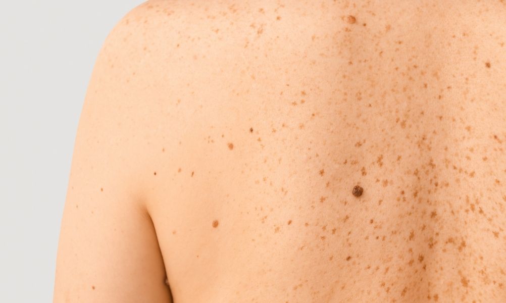 Cómo saber si un lunar es peligroso