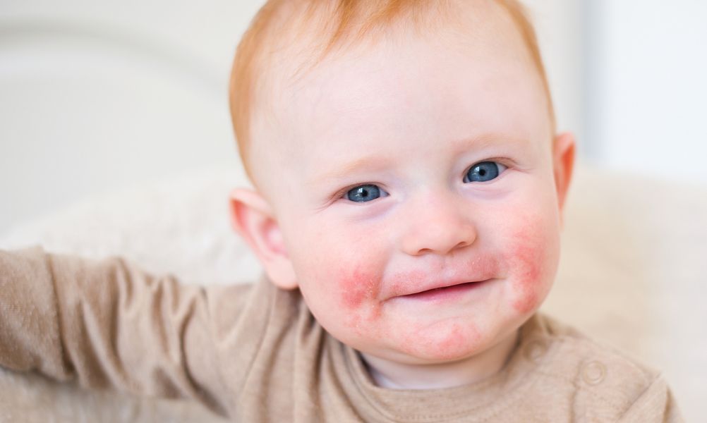 Dermatitis atópica en niños