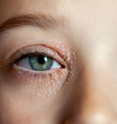 eccema atópico infantil