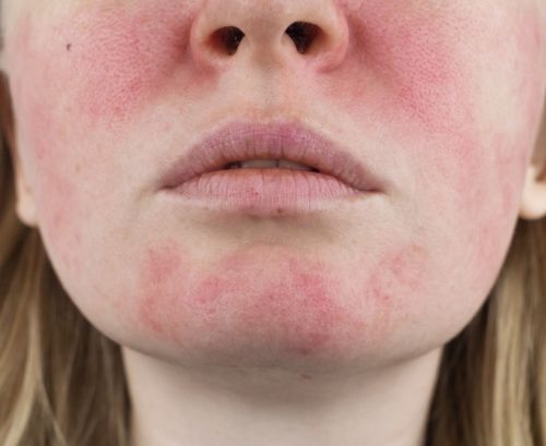 ¿Qué es la rosácea?