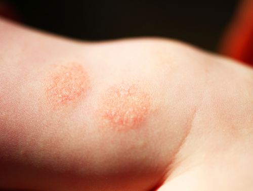 tratamiento dermatitis atópica niños