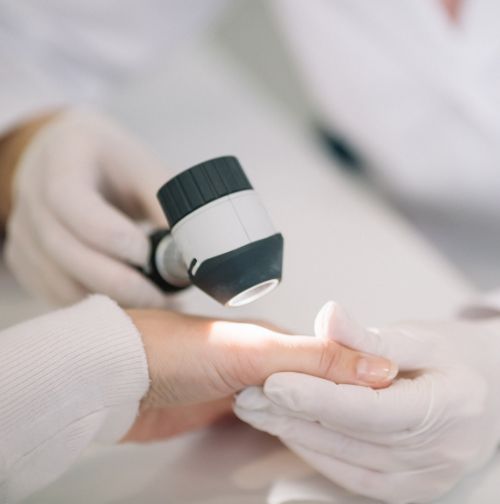 eliminar queratosis seborreica