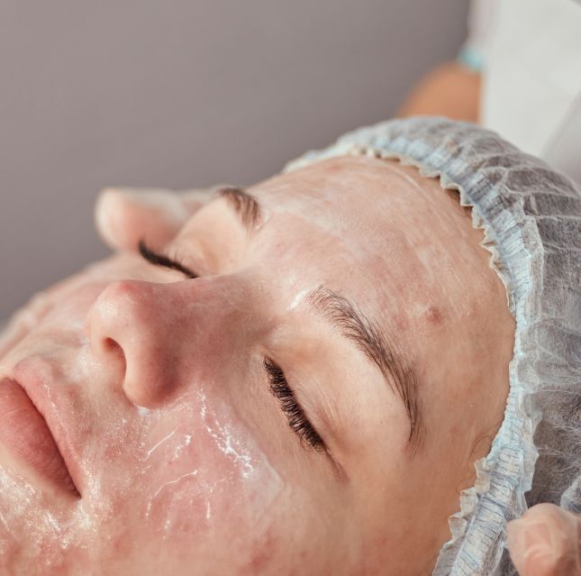 Prodecimientos en clínica Sevilla acné