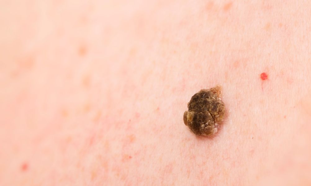 queratosis seborreica