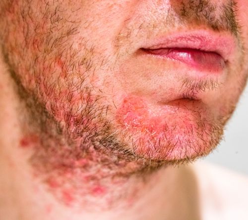 tratamiento queratosis seborreica