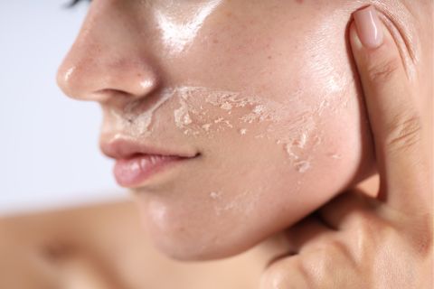 protector solar melasma