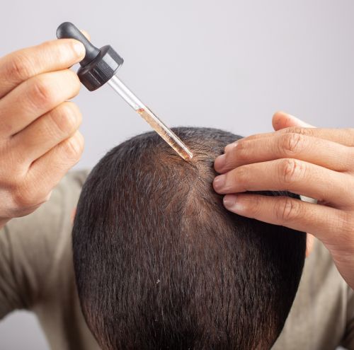 Cómo se utiliza el minoxidil