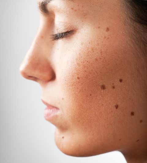 Signos de alarma de un lunar